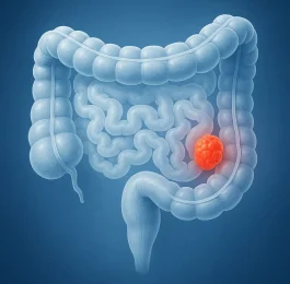 سرطان کولورکتال