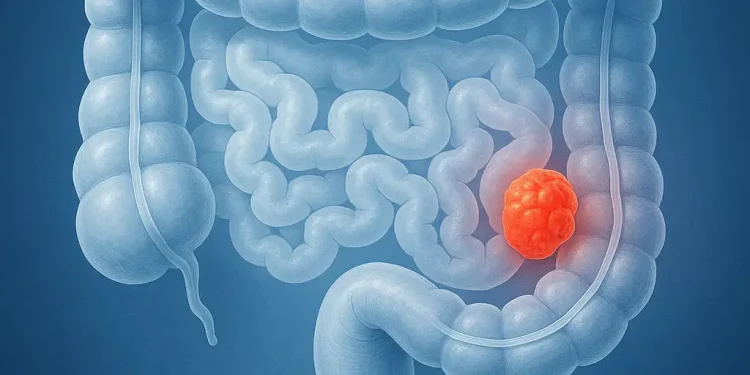 سرطان کولورکتال